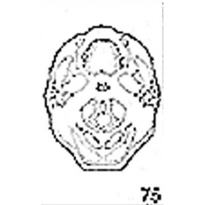 Anatomical Drawings, CT, Base of Skull